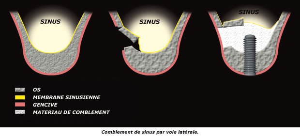 sinus-lateral