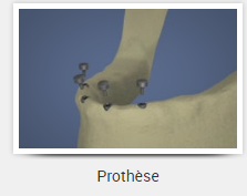 Prothèse