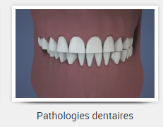 Pathologies dentaires