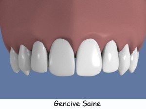 gencive-saine-legende2-300x225